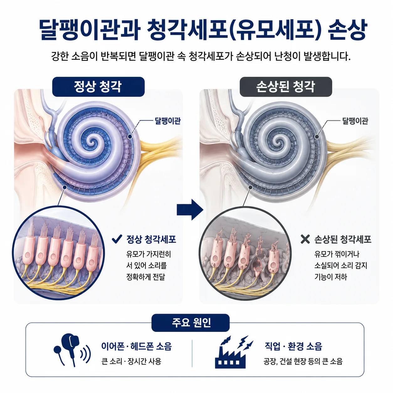 큰 소음에 손상되는 달팽이관 속 청각세포(외유모세포) 개념도