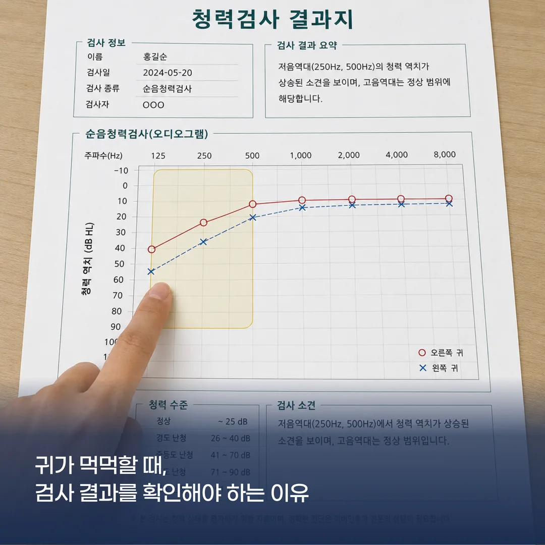 저음역대 청력 저하를 보여주는 순음청력검사 오디오그램