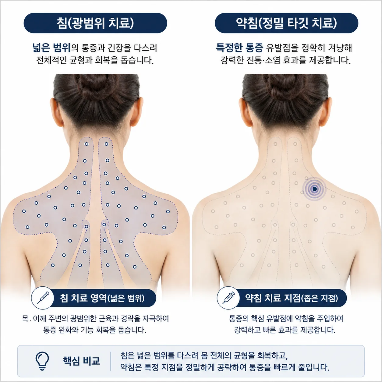 교통사고 치료에서 침이 다루는 넓은 범위와 약침이 겨냥하는 좁은 지점 비교